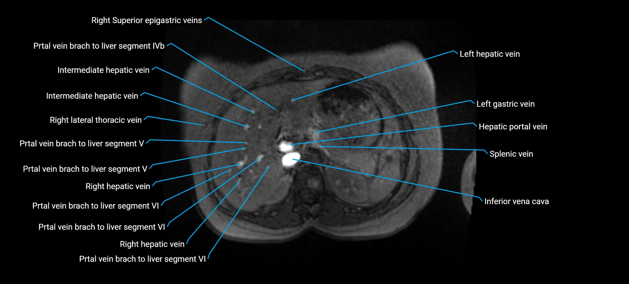 MRV abdomen pelvis & lower limb axial cross sectional anatomy labelled MRI image 45 (1).webp